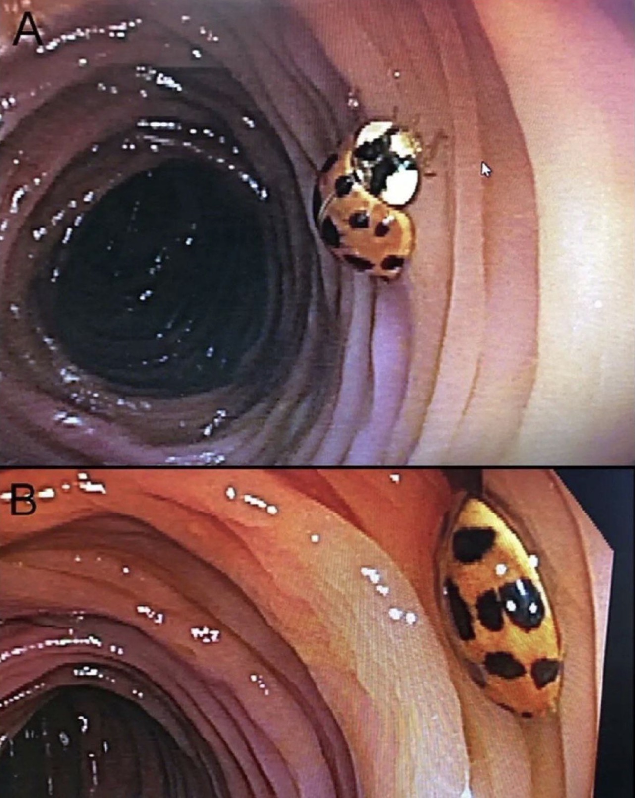 ladybug found in colonoscopy - A B